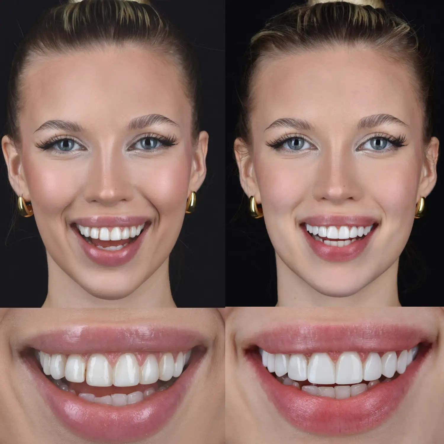 Zdjęcie przedstawia efekty przed i po metamorfozie uśmiechu Natalii Oleś za pomocą bondingu w Unident Union.