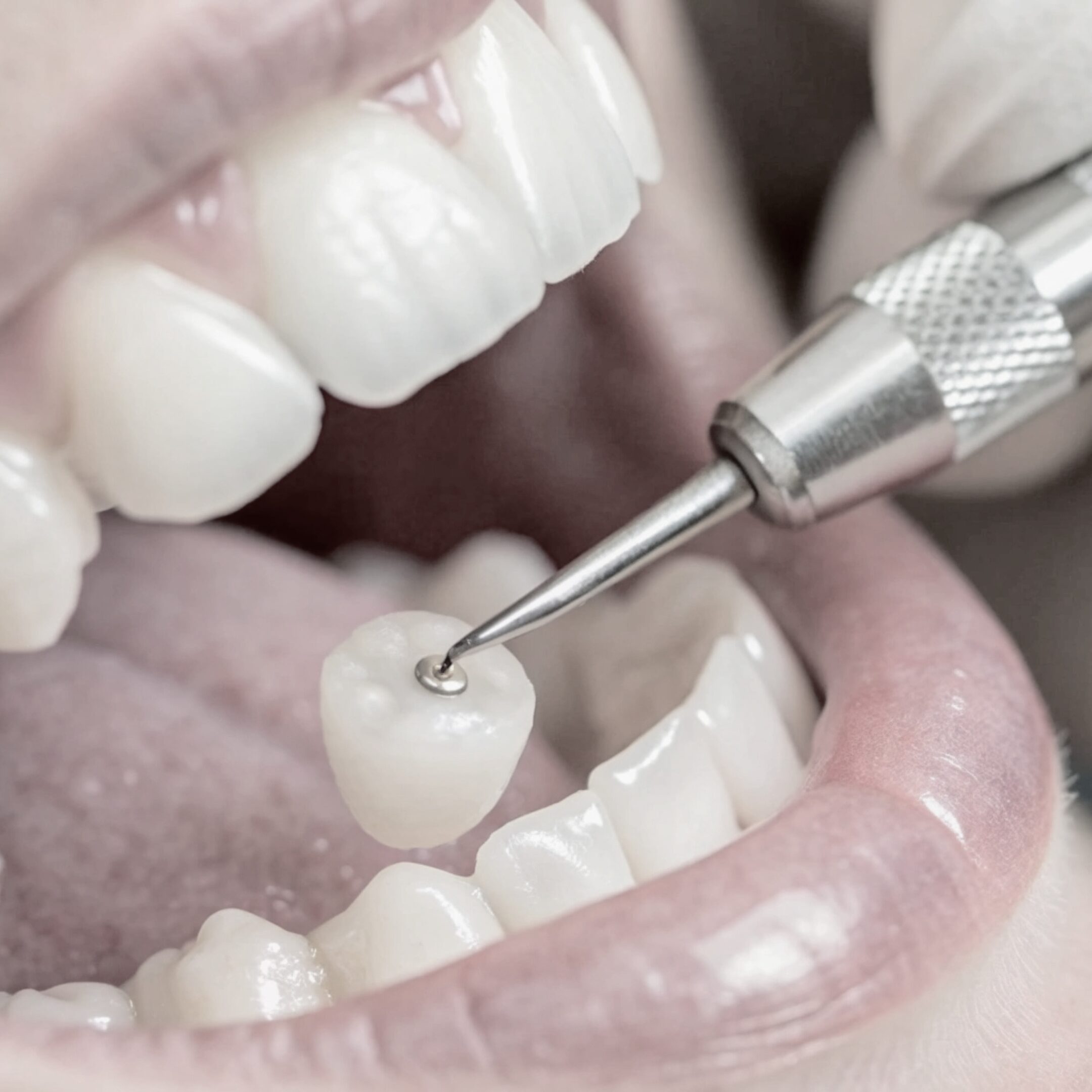 Zbliżenie na otwarte usta osoby u dentysty, pokazujące wiertło dentystyczne pracujące nad zębem - prawdopodobnie przygotowujące do założenia korony lub wypełnienia. Scena przedstawia pierwsze kroki w kierunku metamorfozy uśmiechu i osiągnięcia nowego uśmiechu.