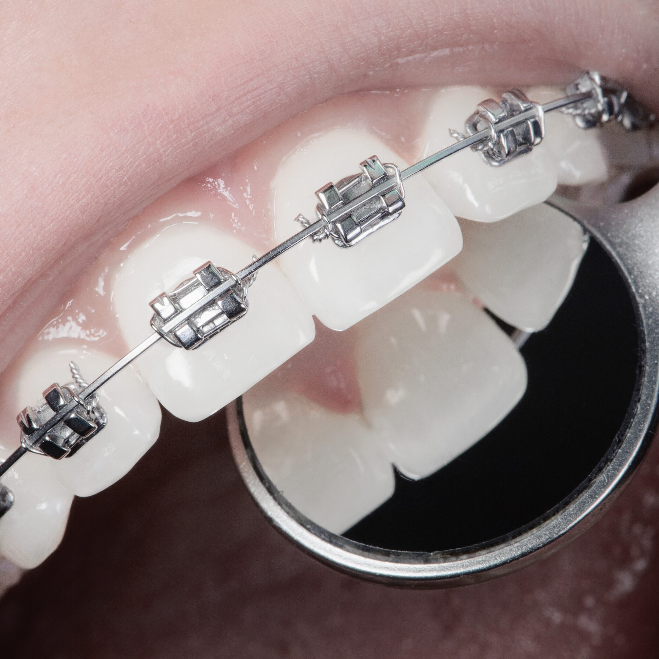 parat z zamkiem samoligaturującym stosowany w Unident Union w leczeniu dorosłych bez ekstrakcji.