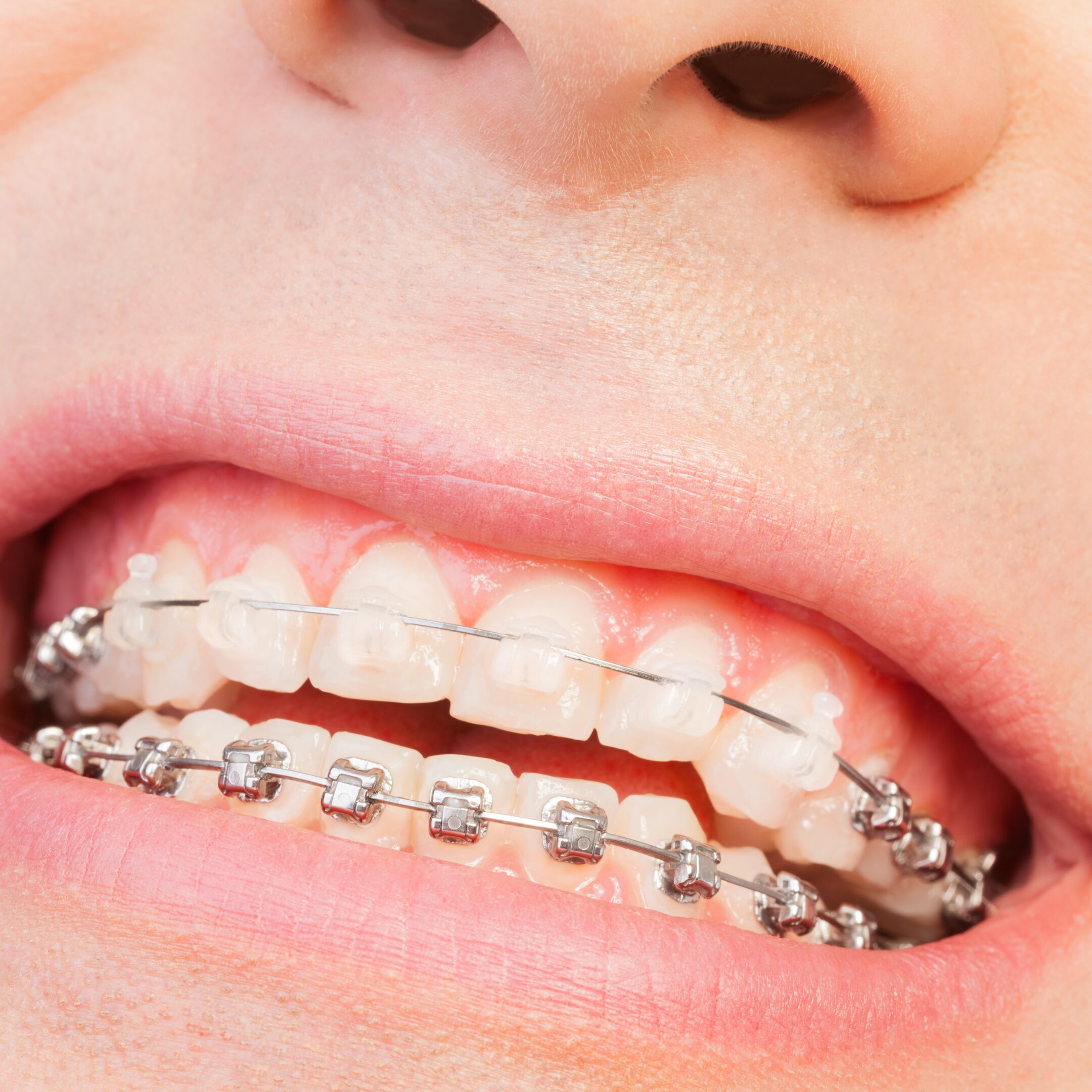 Turbosy ortodontyczne – Unident Union