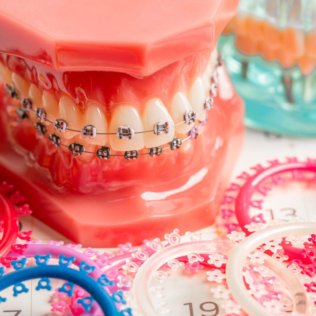 Czy aparaty samoligaturujące są mniej bolesne? | Unident Union