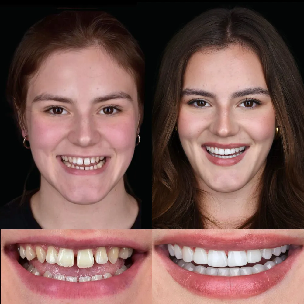 Leczenie ortodontyczne aparatem stałym, wybielanie zębów, bondingi ostateczne.