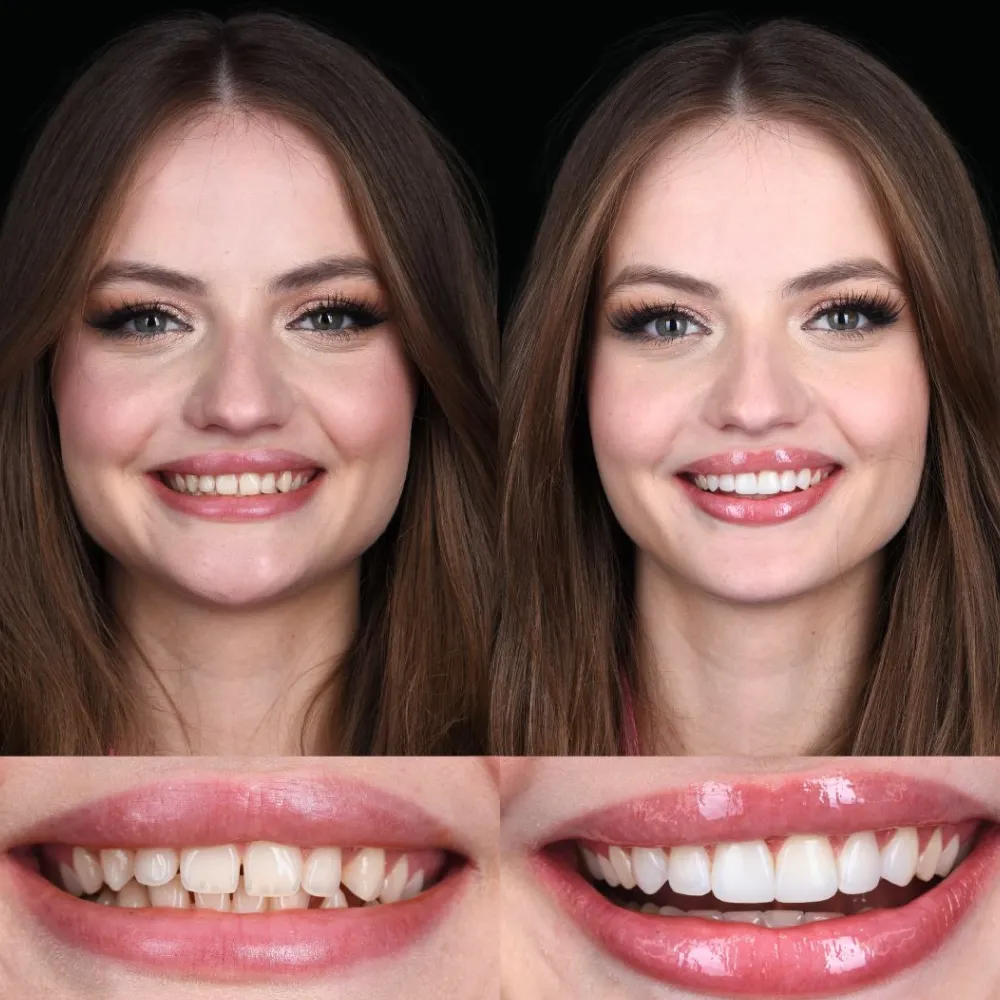 Wybielanie zębów bonding, licówki kompozytowe