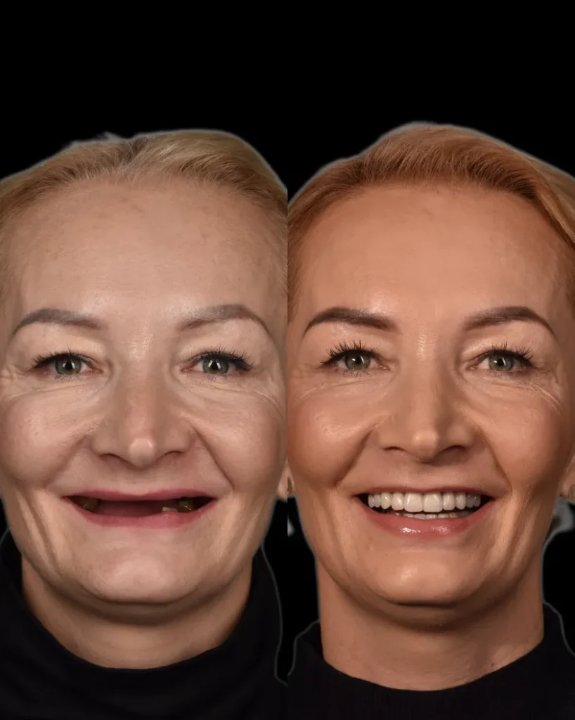 Wszczepienie implantów All-on-4 w strefie; most kompozytowy na 4 implantach w strefie.