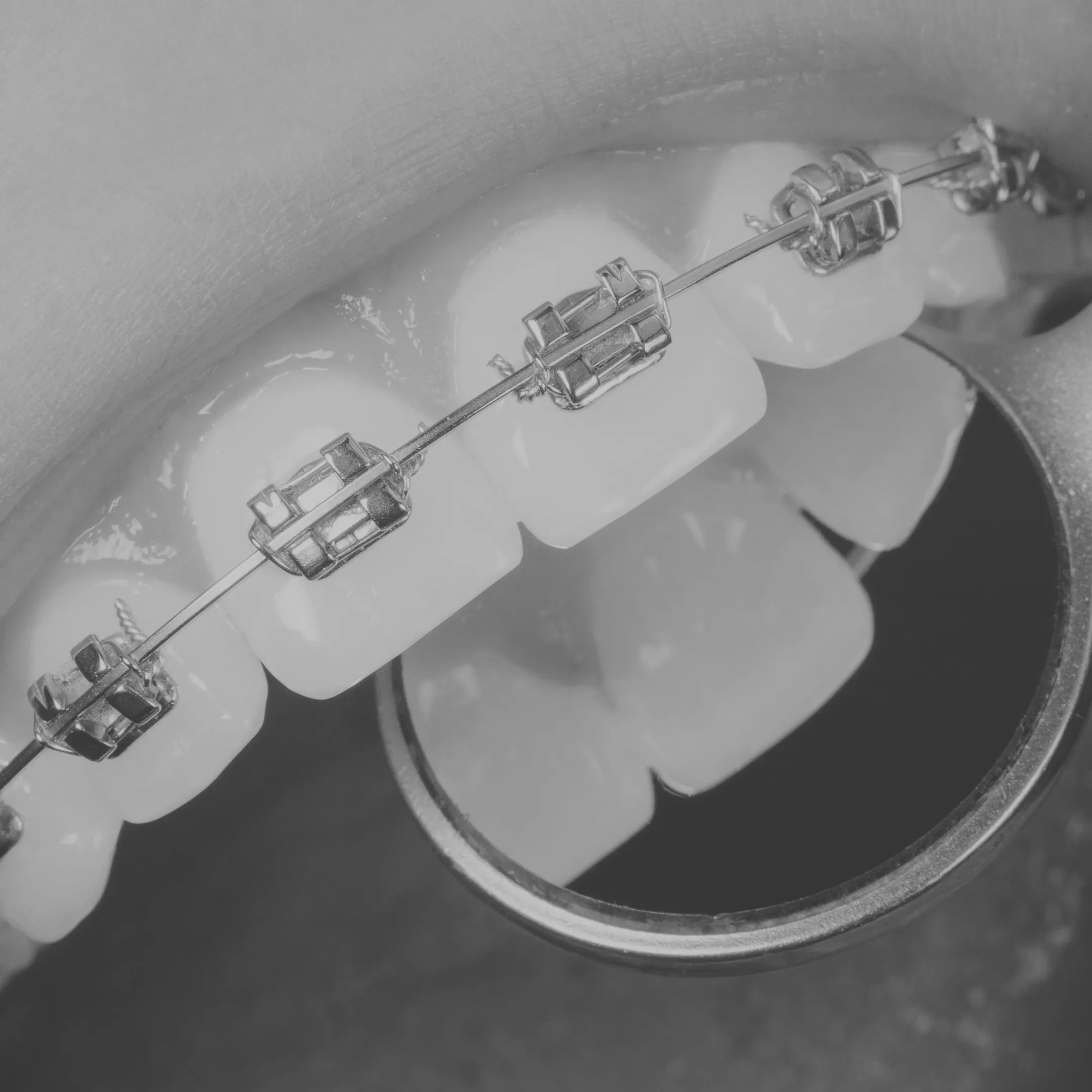 Zamki samoligaturujące stosowane w Unident Union pozwalają prowadzić leczenie dorosłych subtelnie, delikatnie i bez agresji wobec tkanek.