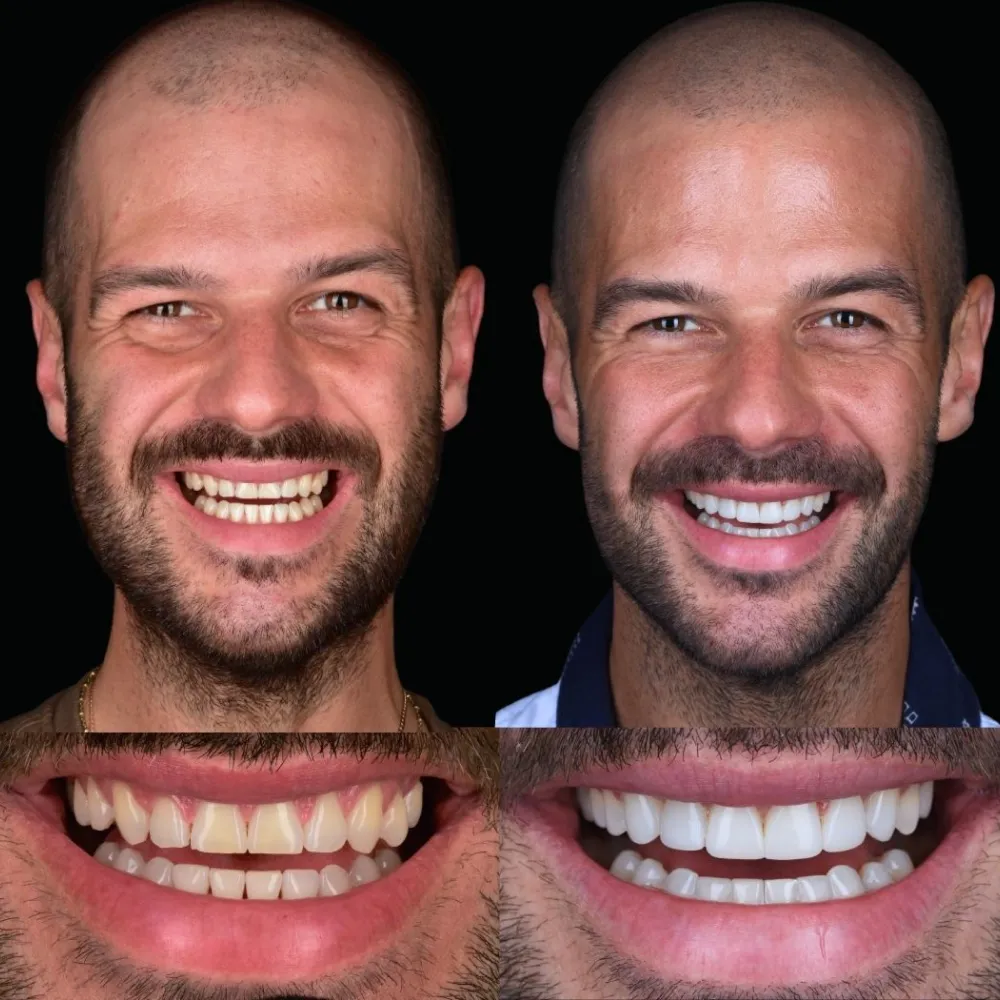 Leczenie ortodontyczne, wybielanie, bondingi ostateczne.