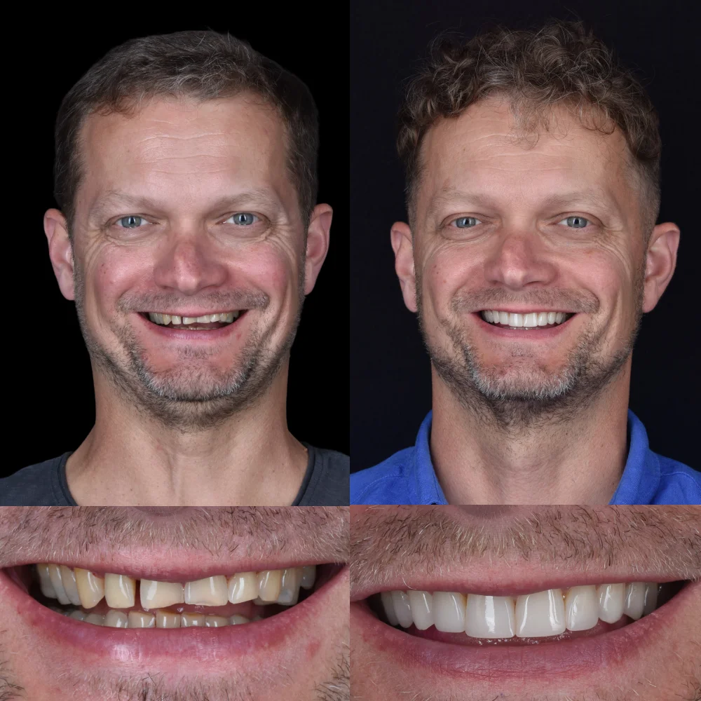 leczenie ortodontyczne aparatem stałym, ekstrakcja ósemek, wybielanie zębów, wymiana wypełnień, bonding projektowy