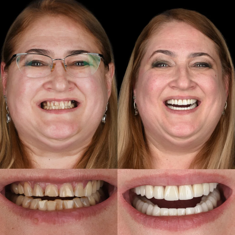 implanty z augmentacją, sinus lift, licówki, korony, mosty protetyczne