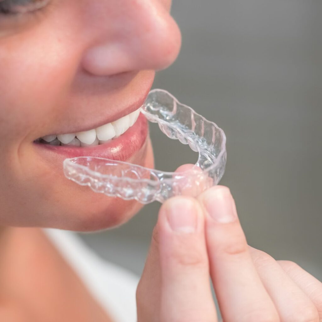 Retencja ortodontyczna u dorosłych – aparat zdjęty, czas na stabilizację | Unident Union Wrocław