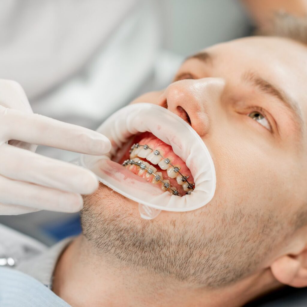 Ortodoncja bezekstrakcyjna – Unident Union Wrocław