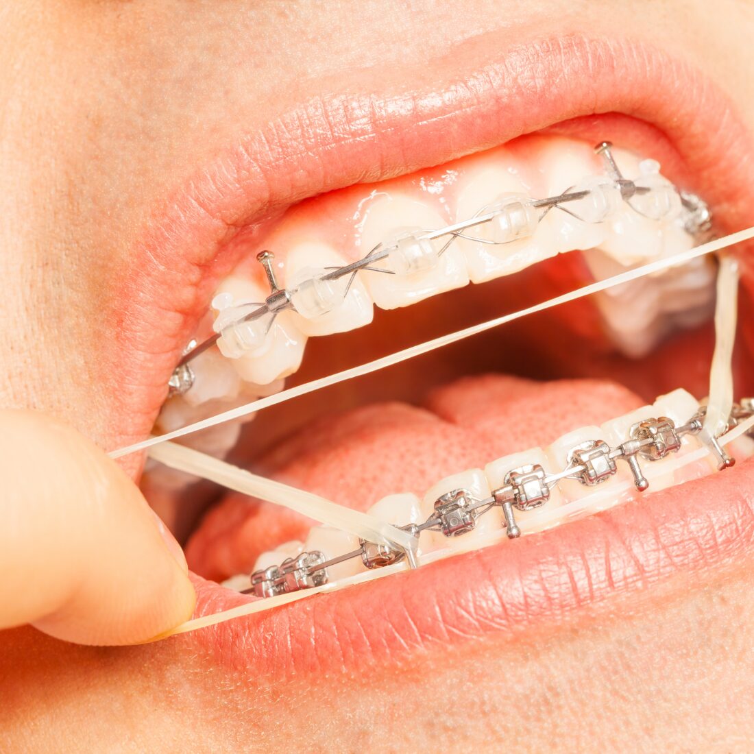 Ortodoncja dorosłych Wrocław – leczenie bez operacji w Unident Union