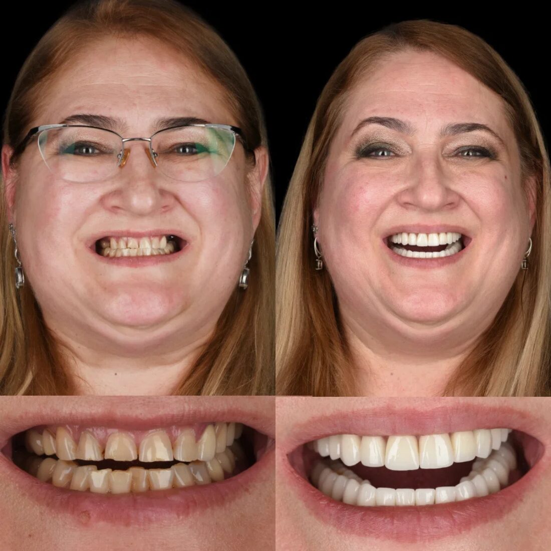 Dowiedz się, ile trwa leczenie ortodontyczne – od kilku miesięcy po 2 lata. Sprawdź harmonogram i wizyty w Unident Union Wrocław.