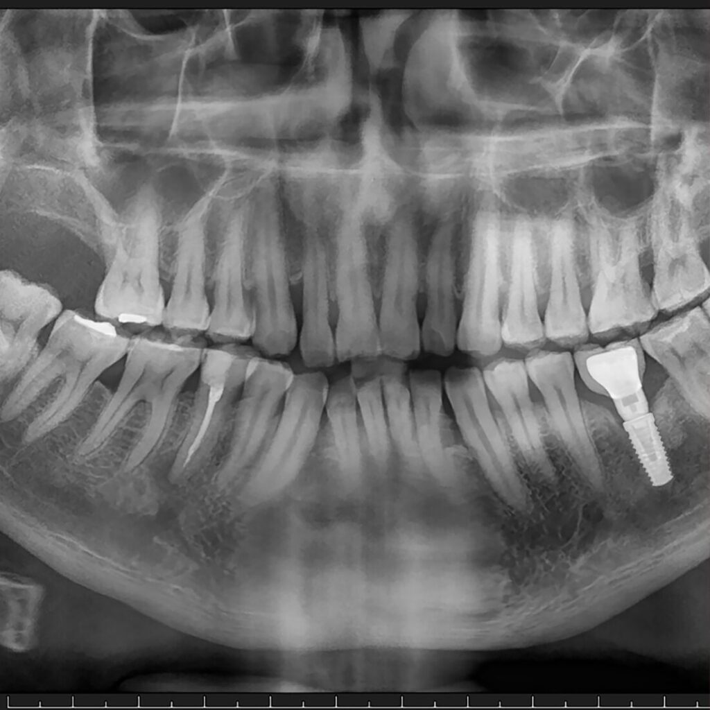 Przestrzeń biologiczna wokół implantu – implantolog Wrocław | Konsultacja