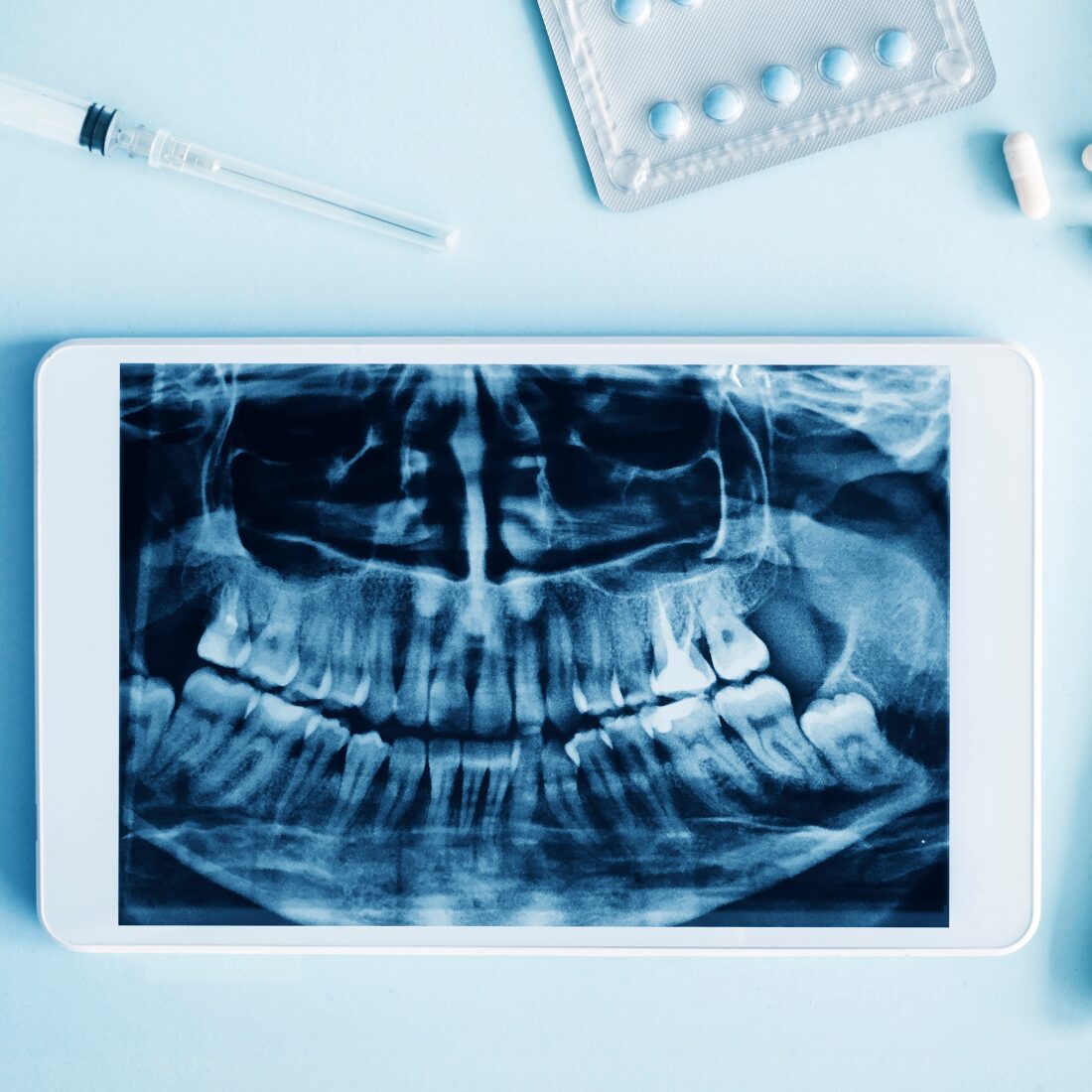 CBCT to fundament nowoczesnej implantologii. Dlaczego nie wykonujemy zabiegów bez obrazu 3D?