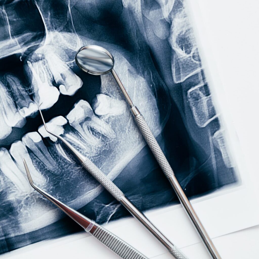 Implant przy stanie zapalnym – kiedy można wykonać implantację natychmiastową?