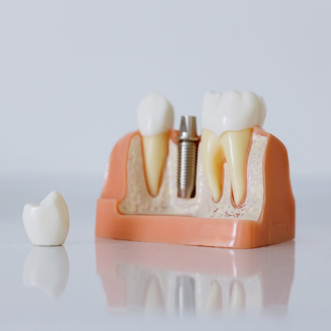 Kiedy można obciążyć implant koroną? 3 scenariusze, które decydują o czasie odbudowy