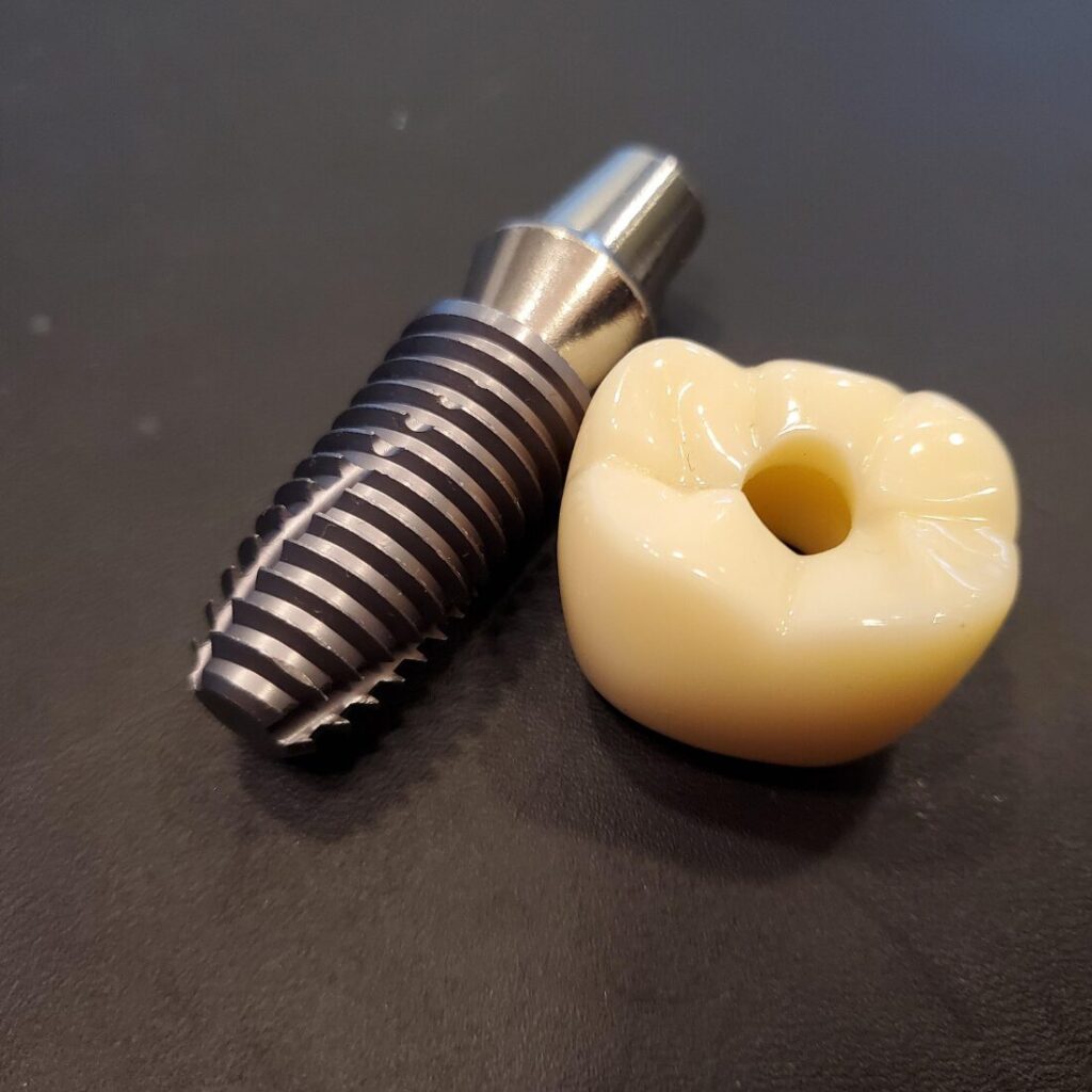 Implant to nie korona – czym się różnią i dlaczego oba etapy są kluczowe? | Wrocław