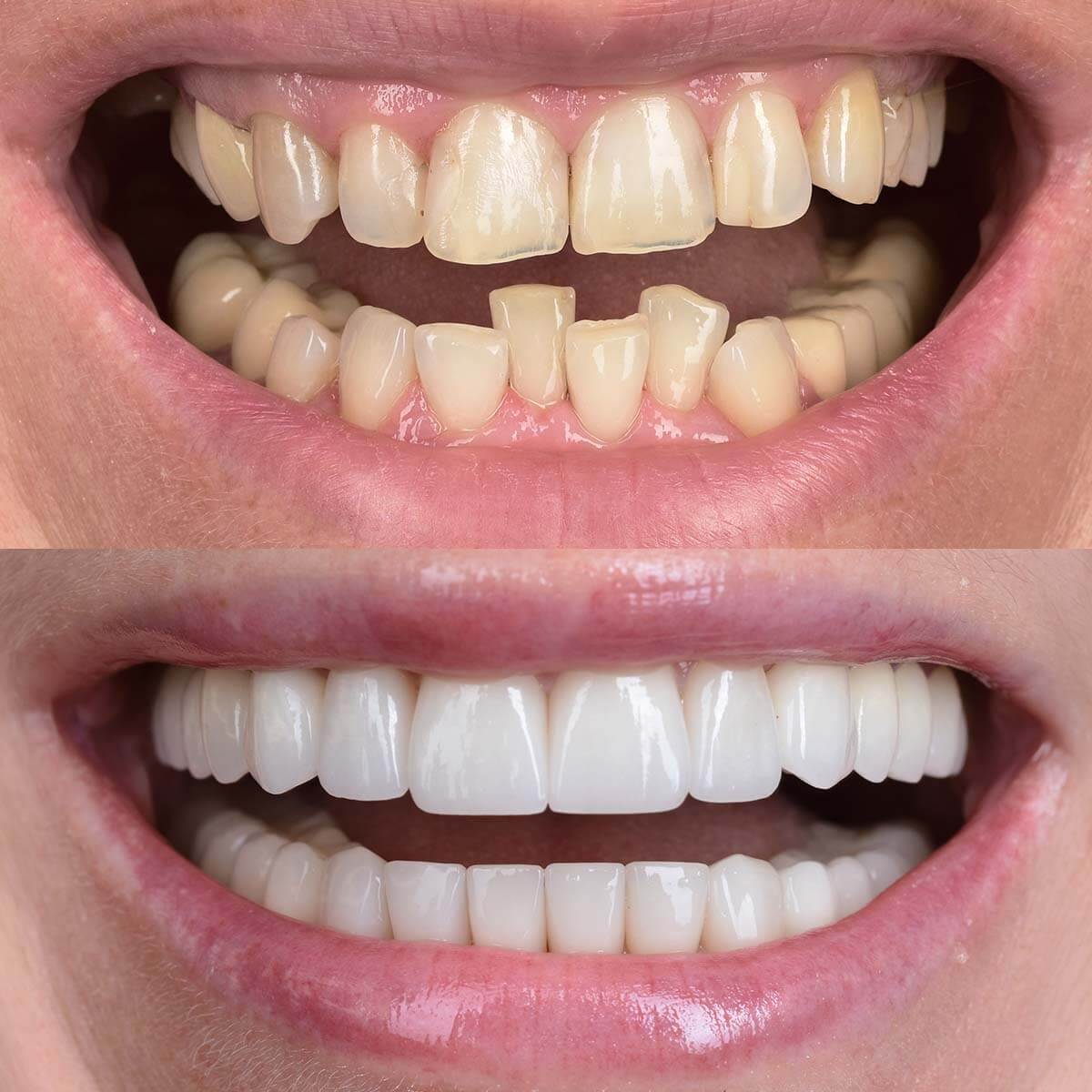 Leczenie aparatem stałym samoligaturującym, praca protetyczna pełnoceramiczna na obu łukach