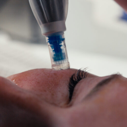 Zbliżenie osoby poddawanej zabiegowi kosmetycznemu na twarz z użyciem urządzenia do mikroigłowania na czole w okolicy brwi. Podczas zabiegu oczy są zamknięte, co podkreśla relaks i dbałość o siebie - krok w kierunku metamorfozy uśmiechu.