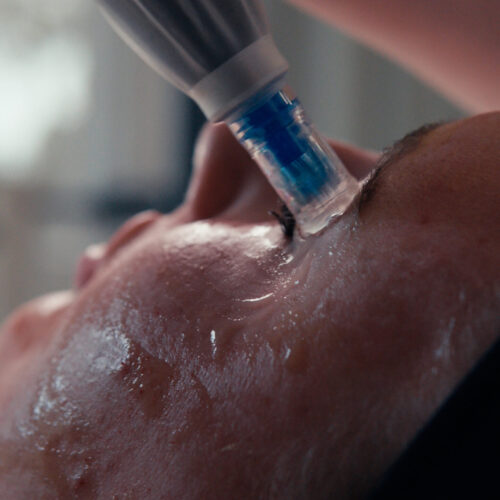 Zbliżenie na osobę poddającą się zabiegowi na twarz z ręcznym urządzeniem na policzku, jej skóra jest mokra i lśniąca - idealne dla osób szukających nowego uśmiechu lub odwiedzających ortodontę dla dorosłych Wrocław.