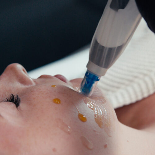 Zbliżenie na osobę poddającą się zabiegowi na twarz, z dłonią w rękawiczce trzymającą urządzenie do pielęgnacji skóry na policzku i kilkoma kroplami serum widocznymi na twarzy. Idealny relaks po wizycie w ortodoncie dla dorosłych Wrocław na metamorfozę uśmiechu.