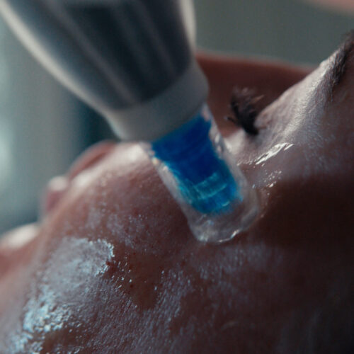 Zbliżenie na osobę poddawaną zabiegowi na twarz, z urządzeniem zasysającym skórę w celu uzyskania błyszczącego, odświeżonego wyglądu. Oko osoby jest zamknięte podczas zabiegu - idealne przygotowanie przed wizytą w ortodonta wrocław na nowy uśmiech.