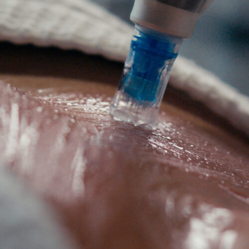 Zbliżenie zabiegu na twarz pokazuje urządzenie do pielęgnacji skóry z niebieską końcówką nakładane na wilgotną skórę, przypominające precyzję spotykaną w klinikach ortodonta wrocław dla osób poszukujących nowego uśmiechu podczas zabiegów dermatologicznych lub spa.