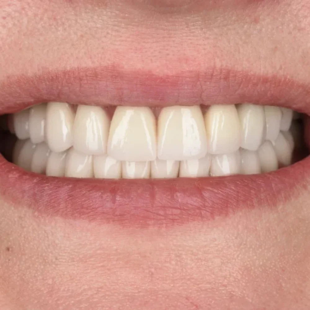 implanty z augmentacją, sinus lift, licówki, korony, mosty protetyczne