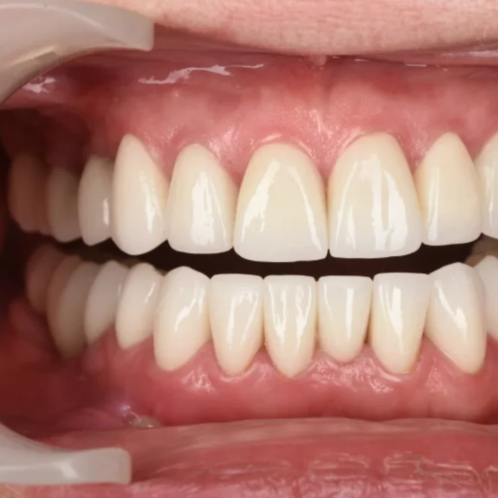 implanty z augmentacją, sinus lift, licówki, korony, mosty protetyczne