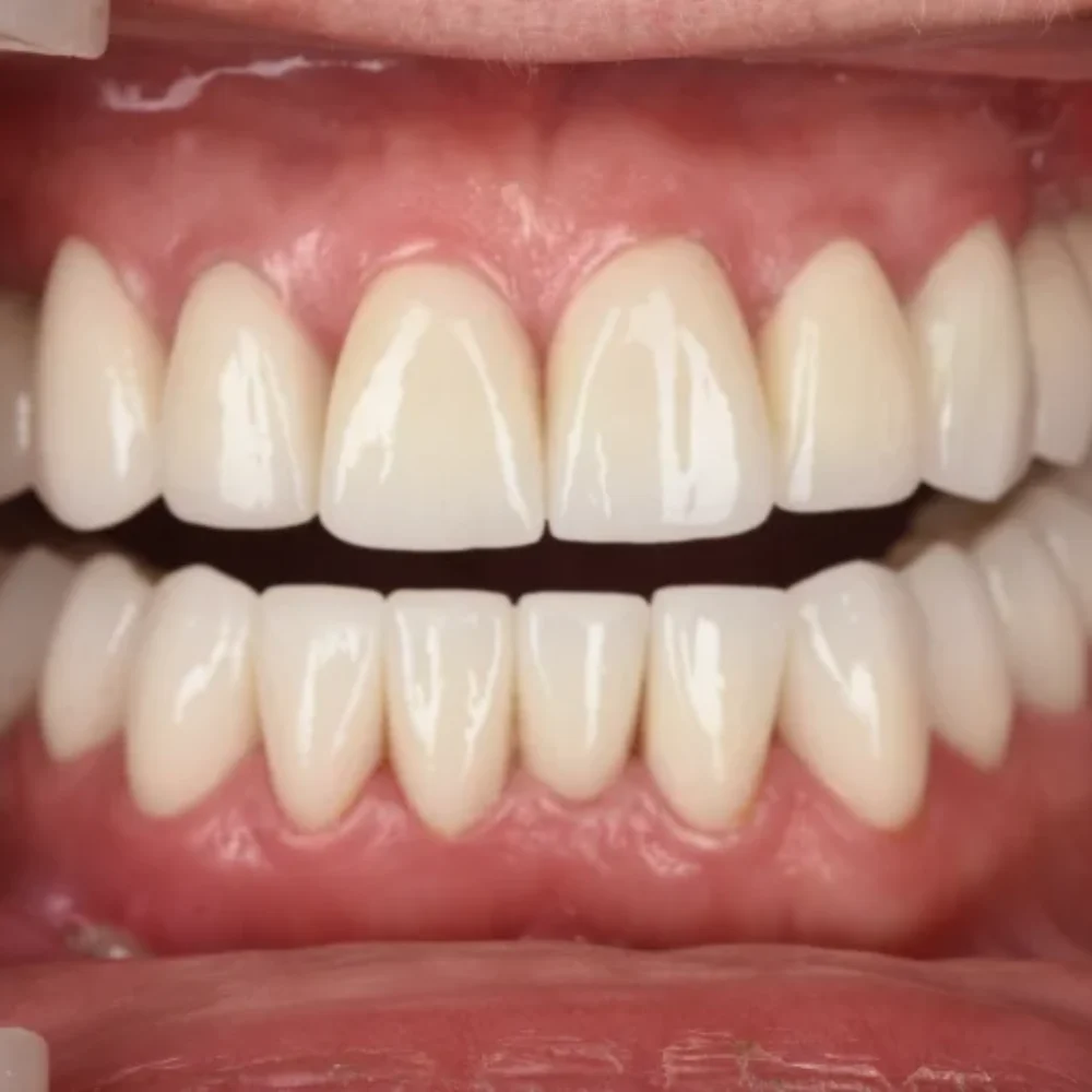 implanty z augmentacją, sinus lift, licówki, korony, mosty protetyczne