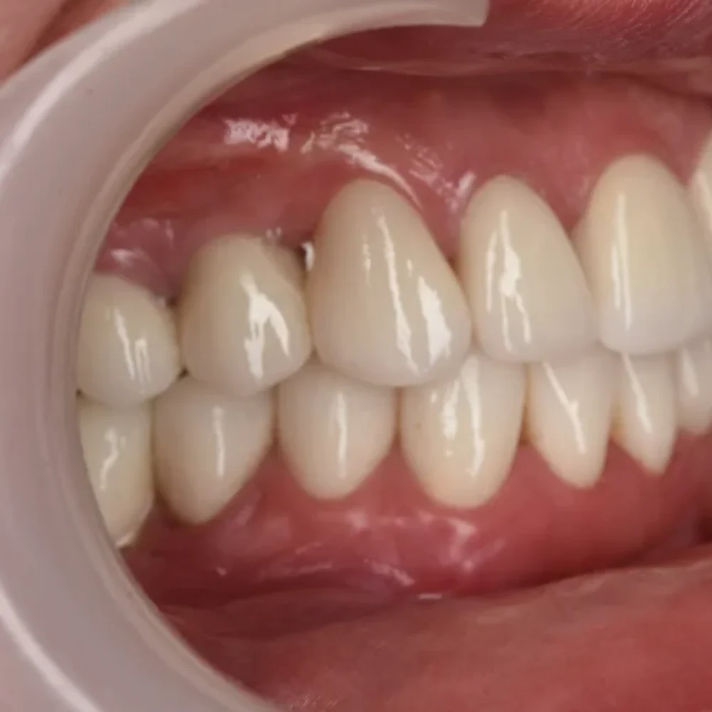 implanty z augmentacją, sinus lift, licówki, korony, mosty protetyczne