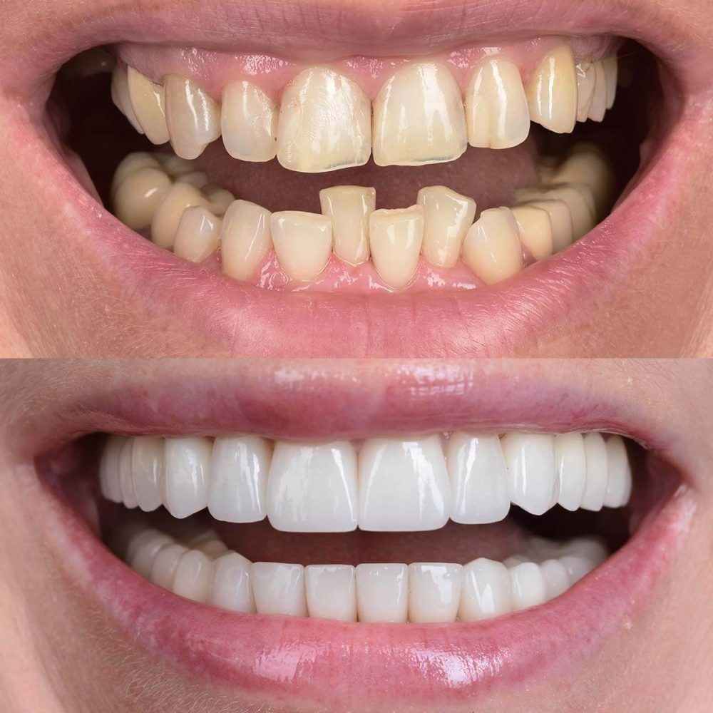 Leczenie aparatem stałym samoligaturującym, praca protetyczna pełnoceramiczna na obu łukach